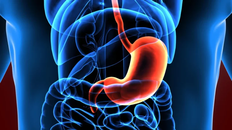 Gastric Sleeve or Bypass?
